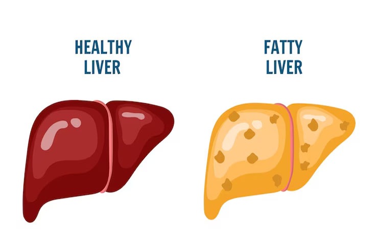 Understanding Fatty Liver: Causes, Symptoms, and Treatment - Dania ...